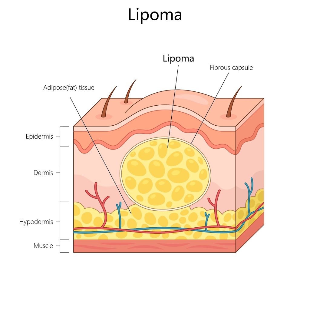 Lipoma removal in Singapore.