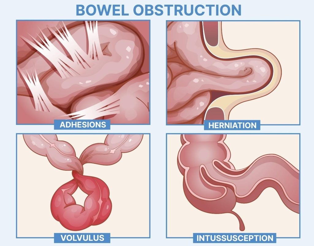 causes of bowel obstruction.