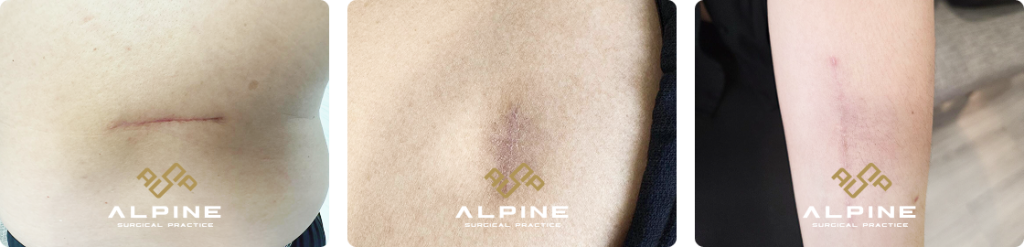 benign skin lesion excision, healing wound care.