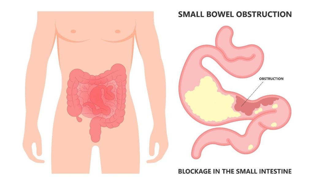 bowel obstruction blockage intestine digestive tract.