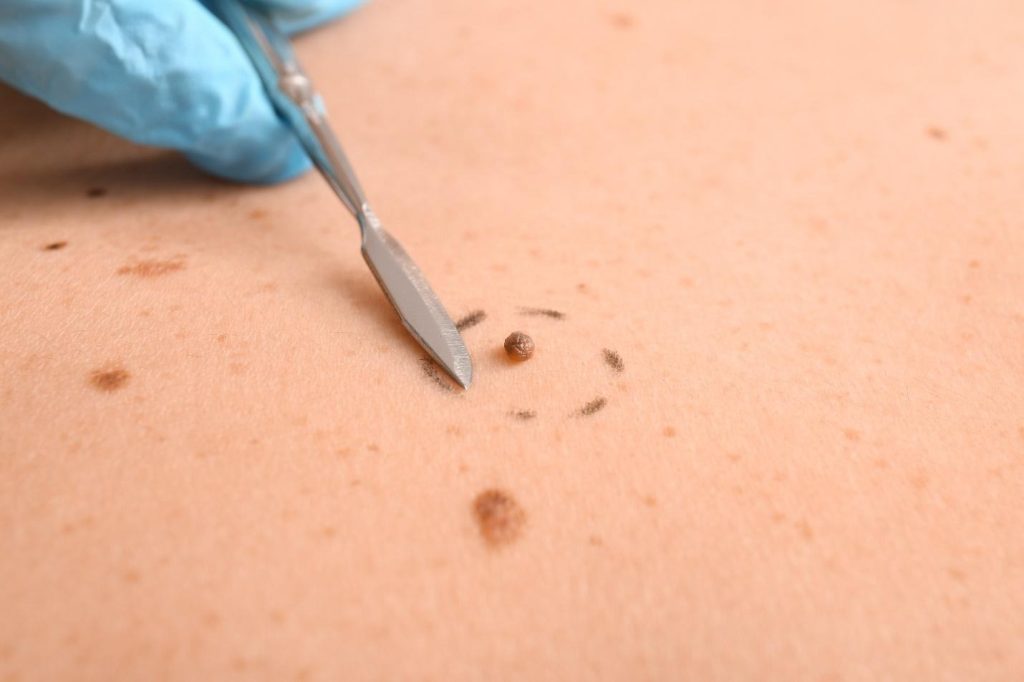 excision of a benign skin lesion procedure in Singapore.