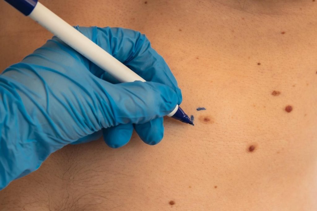 benign skin lesion surgical removal.