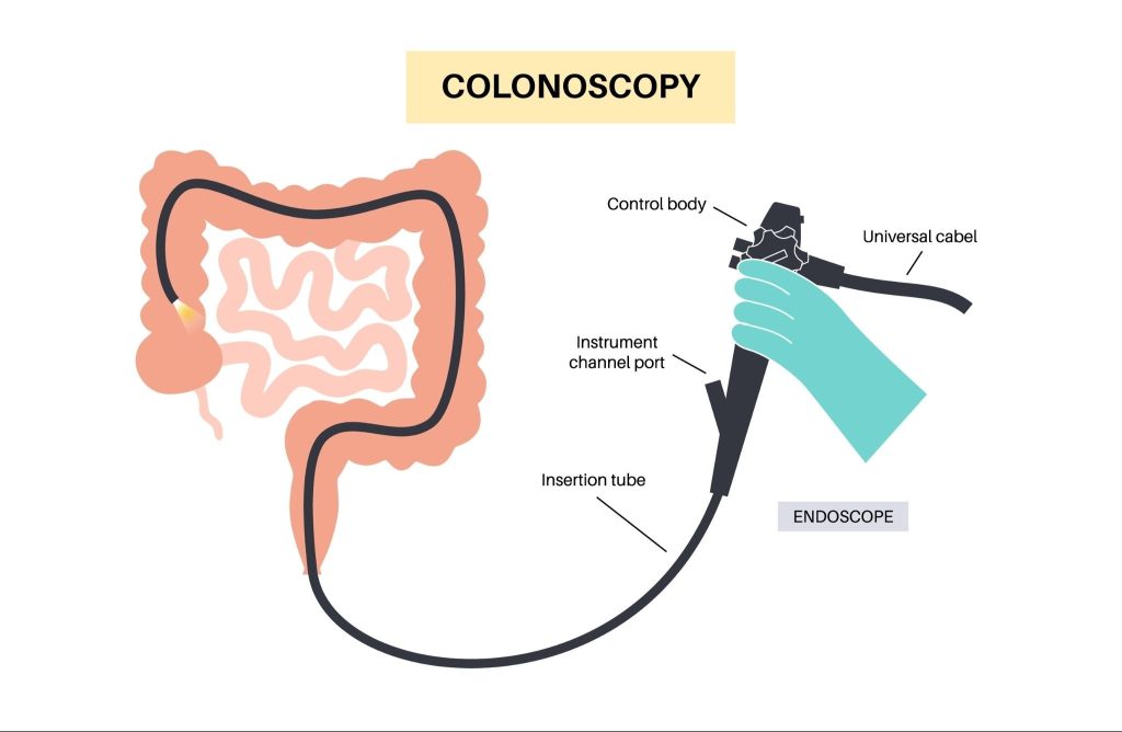 Colonoscopy Singapore