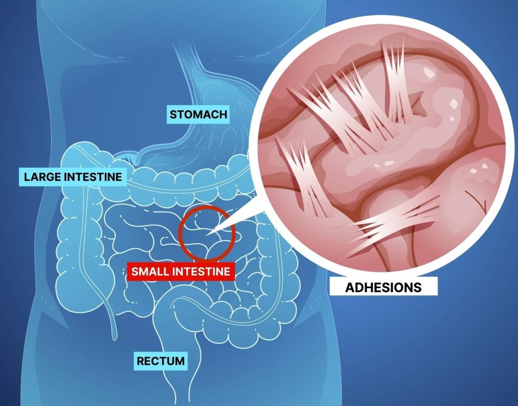 abdominal adhesions scar tissue.