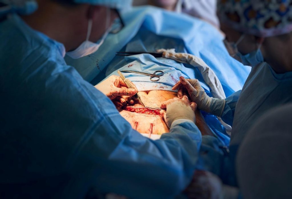 abdominal adhesions risk factors.