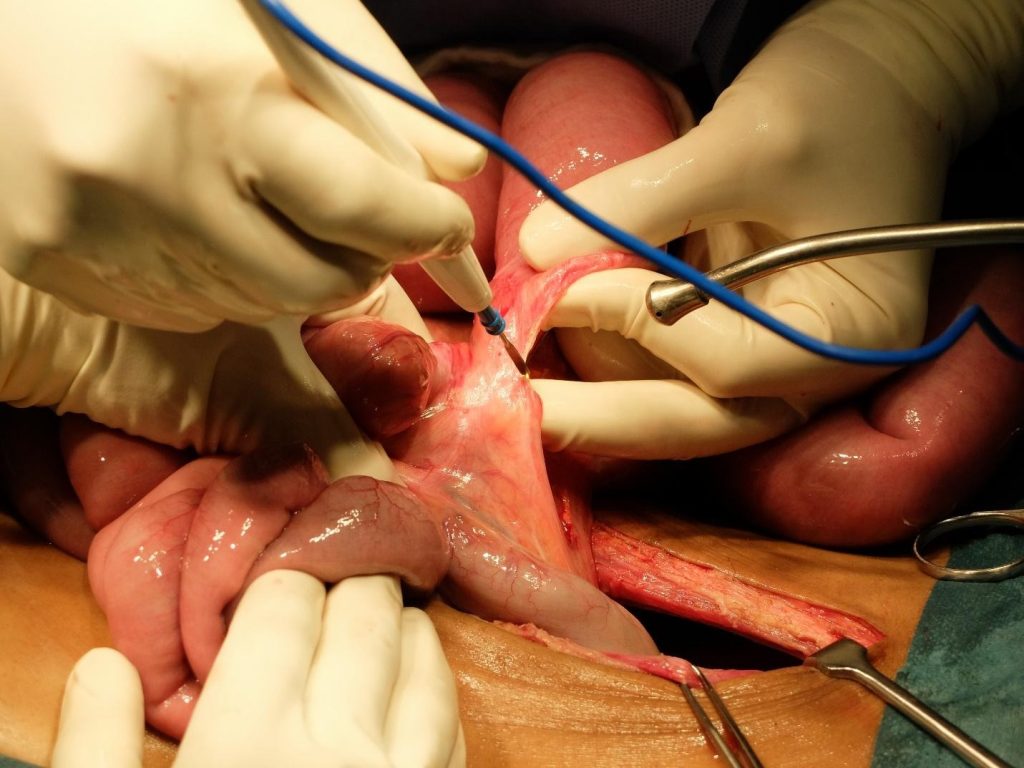 abdominal adhesions diagnosis.